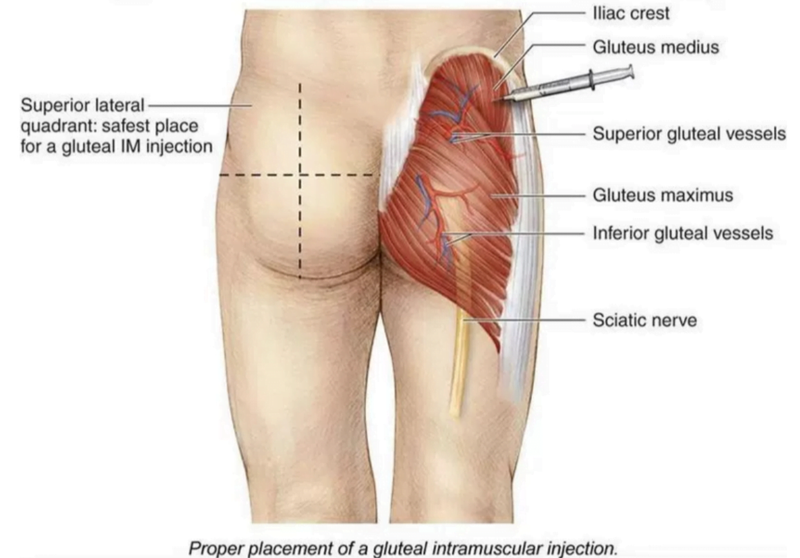 steroid injection site